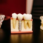 Implanty zębowe – Najczęściej zadawane pytania