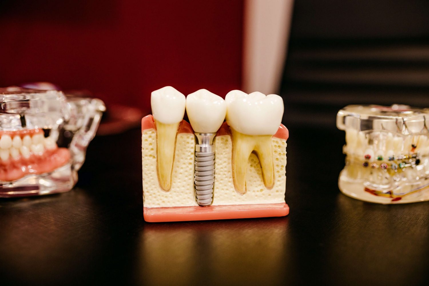 Implanty zębowe – najczęściej zadawane pytania