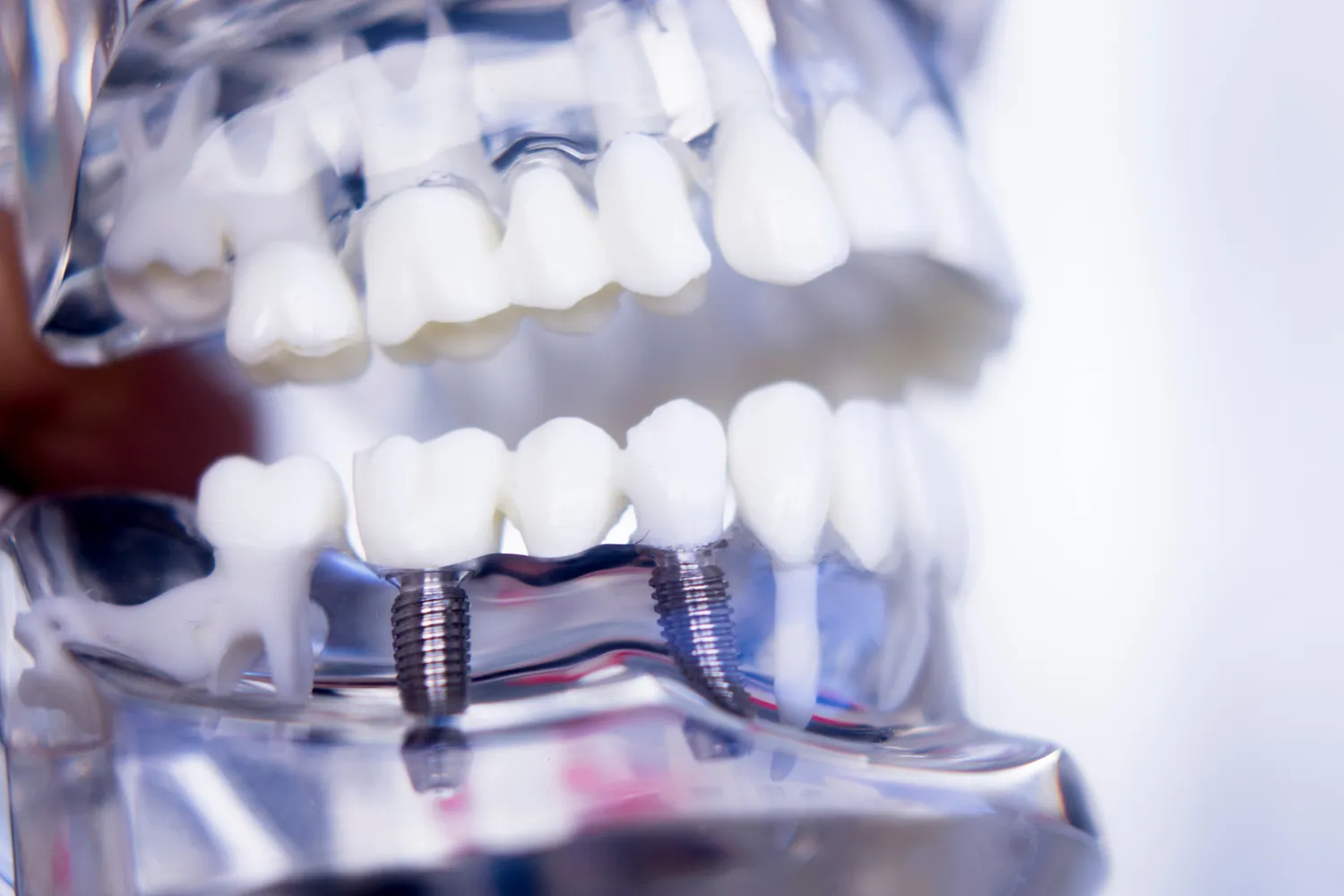 Co trzeba wiedzieć o implantach zębowych?