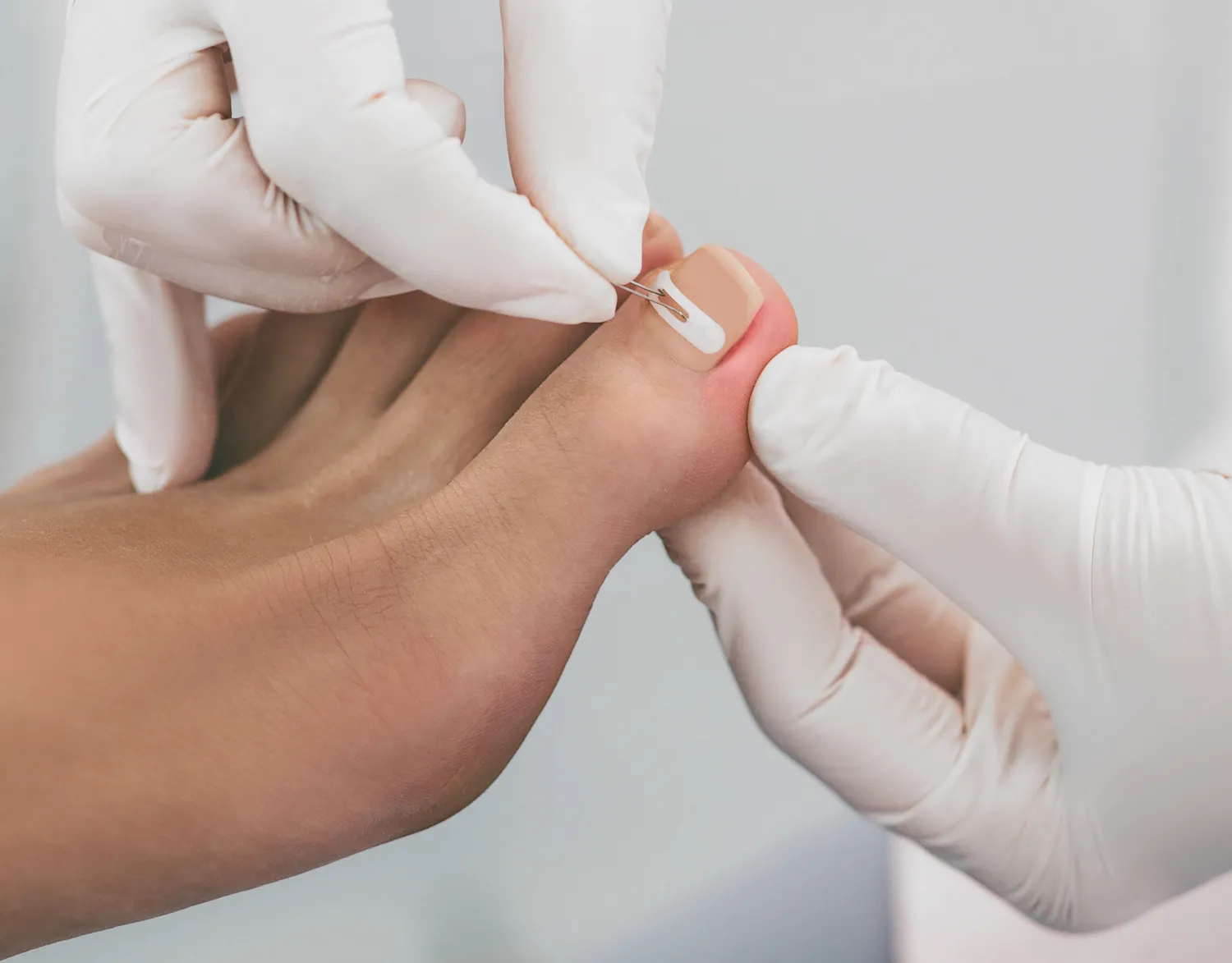 Pedicure leczniczy - czym jest i na jakie efekty możesz liczyć?
