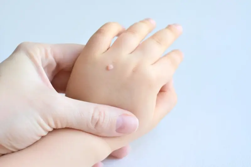 Kurzajki podolog czy dermatolog?